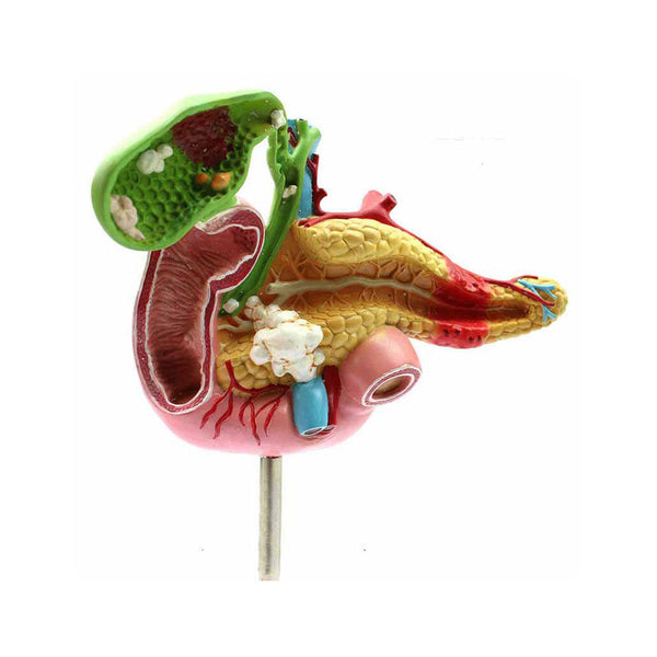 Pathological Model of Pancreas, Duodenum, Gallbladder